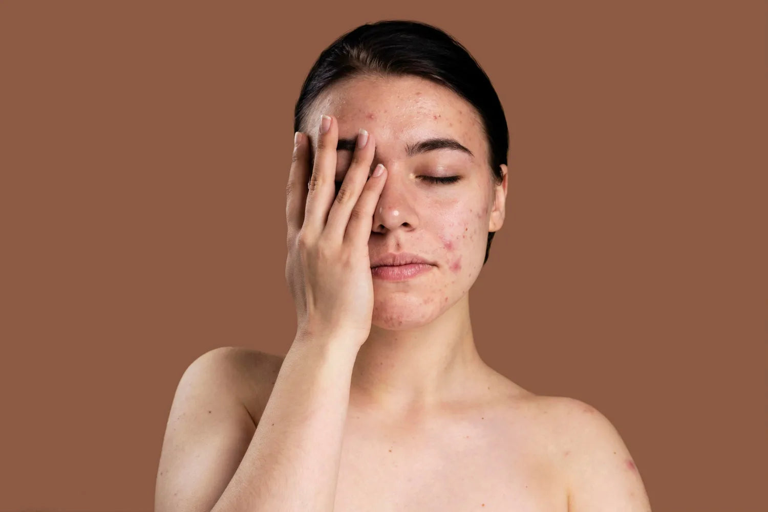 Oily and acne-prone skin care